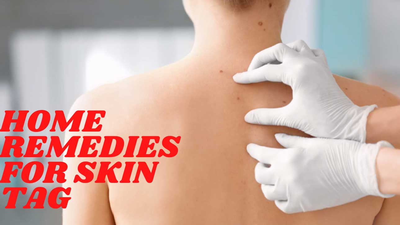 Home Remedies for Skin Tag